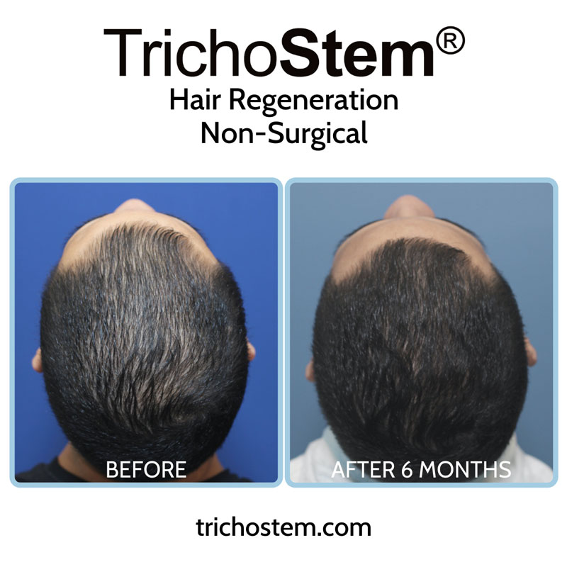 Effectiveness of TrichoStem® Hair Regeneration treatment after 6 months with a single injection