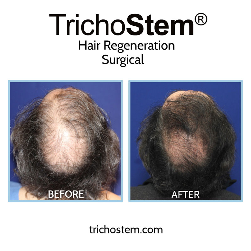 Prior to discovering TrichoStem® Hair Regeneration, Dr. Amiya Prasad already had extensive experience with hair loss treatment, including hair transplants and prescribing finasteride.
