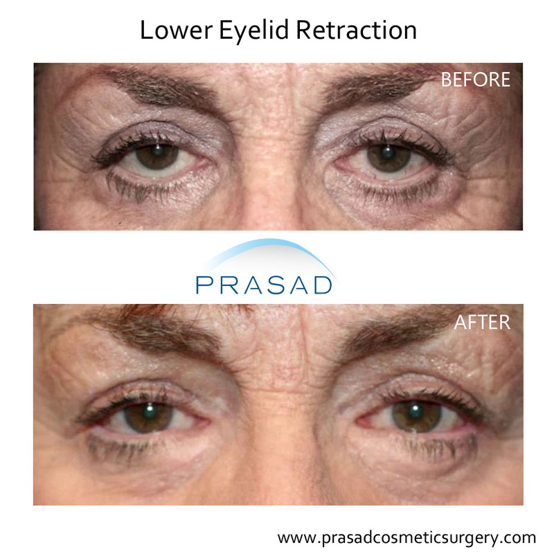 before and after lower eyelid retraction - older female patient