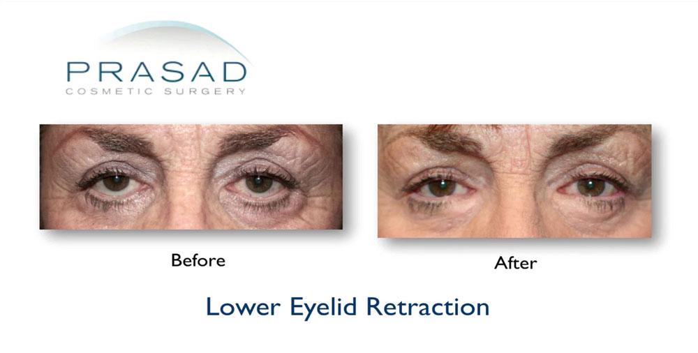 before and after Lower eyelid retraction
