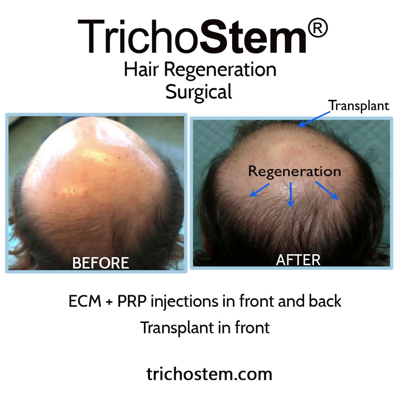 Dr. Prasad developed TrichoStem® Hair Regeneration after observing that extracellular matrix by ACell