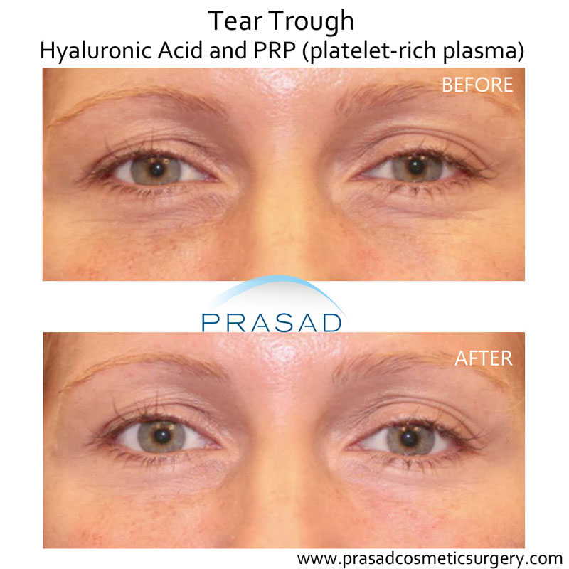Prasad Cosmetic Surgery has made PRP the go-to treatment for under eye dark circles over the years. Tear trough treatment before and after.