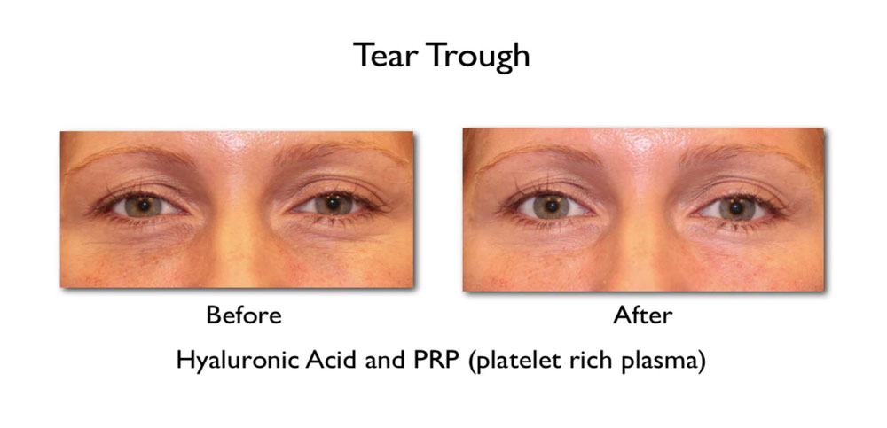 Prasad Cosmetic Surgery has made PRP the go-to treatment for under eye dark circles over the years. Tear trough treatment before and after