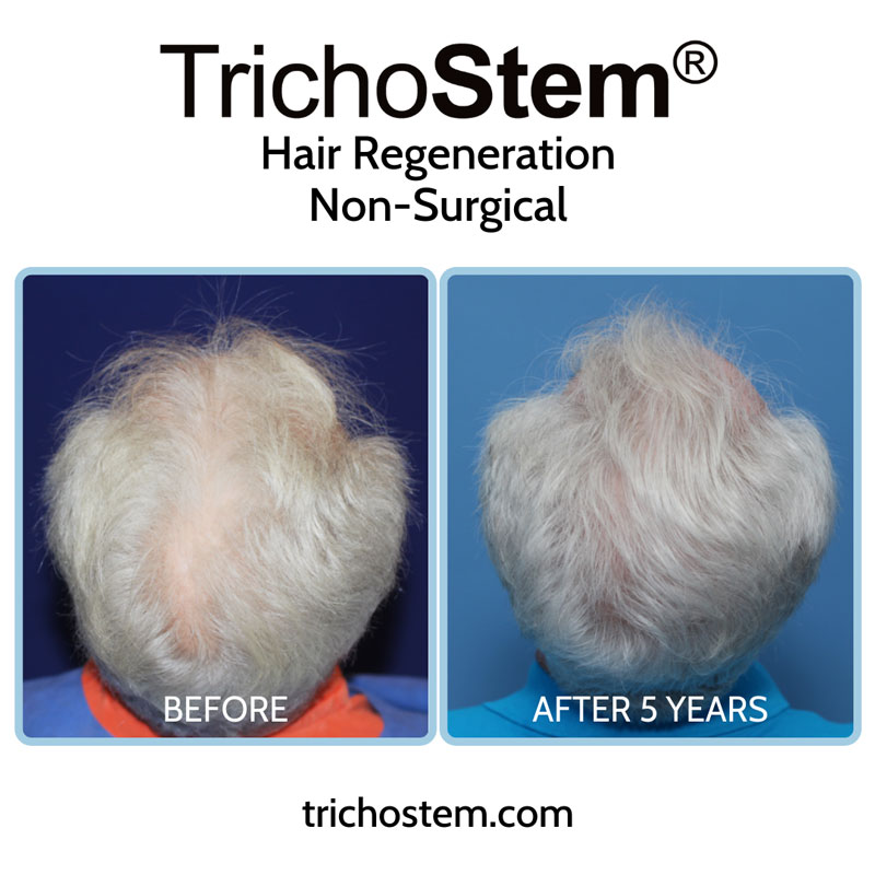 TrichoStem® Hair Regeneration results in a male patient with moderate hair thinning 5 years after a single injection and no finasteride.