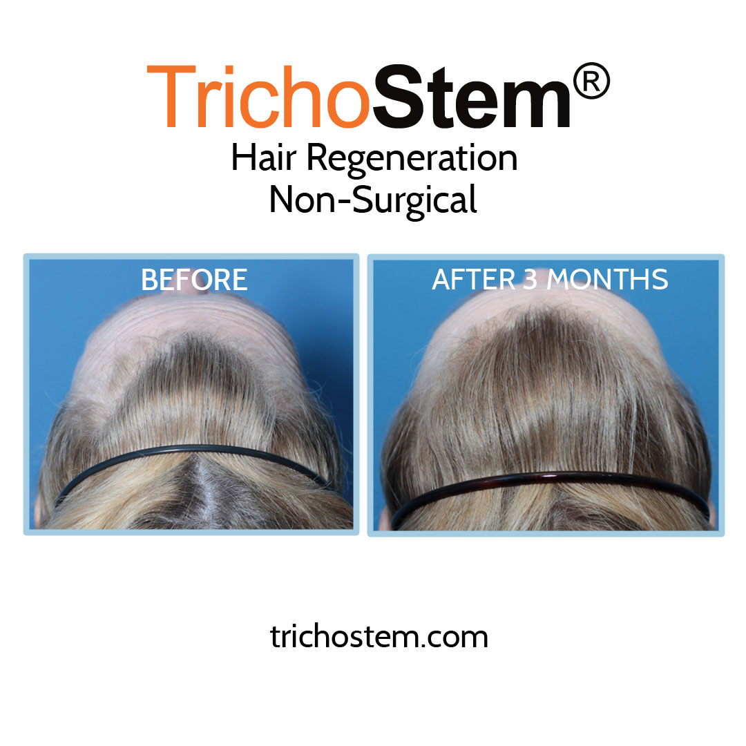 One of our female pattern hair loss patients 3 months after a single injection of TrichoStem Hair Regeneration.