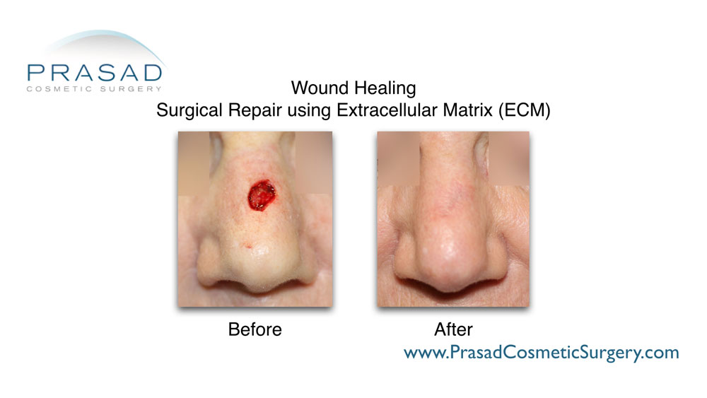Extracellular matrix used to improved healing of facelift incisions, and regenerative/reconstructive surgery