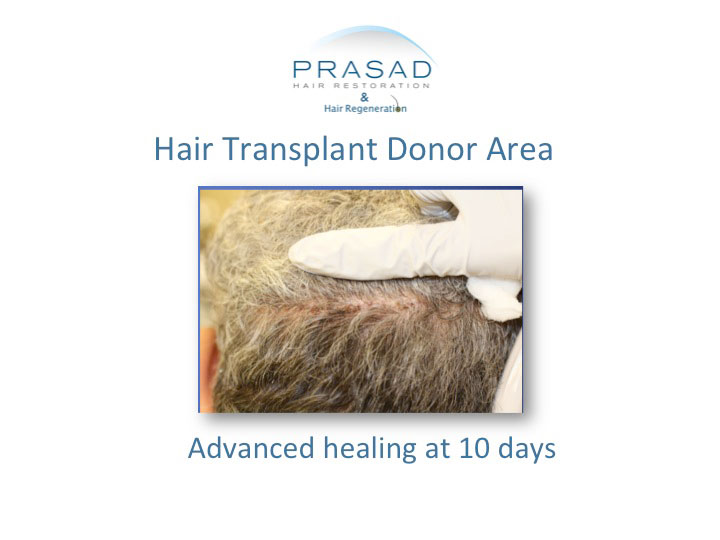 hair transplant donor area, advance healing at 10 days
