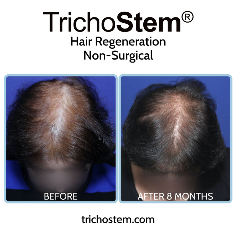 TrichoStem customized treatment formulations are more effective than standardized formulations