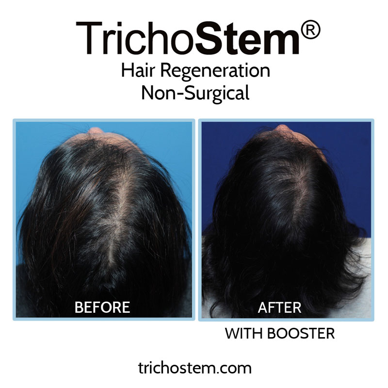 A second TrichoStem™ Hair Regeneration injection can be administered 15-24 months after the initial treatment to thicken fine hair growth from the first treatment, at no extra charge