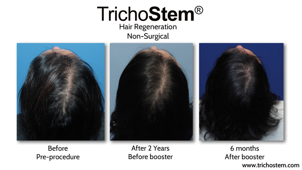 A second TrichoStem™ Hair Regeneration injection can be administered 15-24 months after the initial treatment to thicken fine hair growth from the first treatment, at no extra charge
