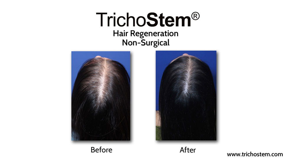 After improving diagnosis of female pattern hair loss, TrichoStem Hair Regeneration attained a 99% success rate of treatment