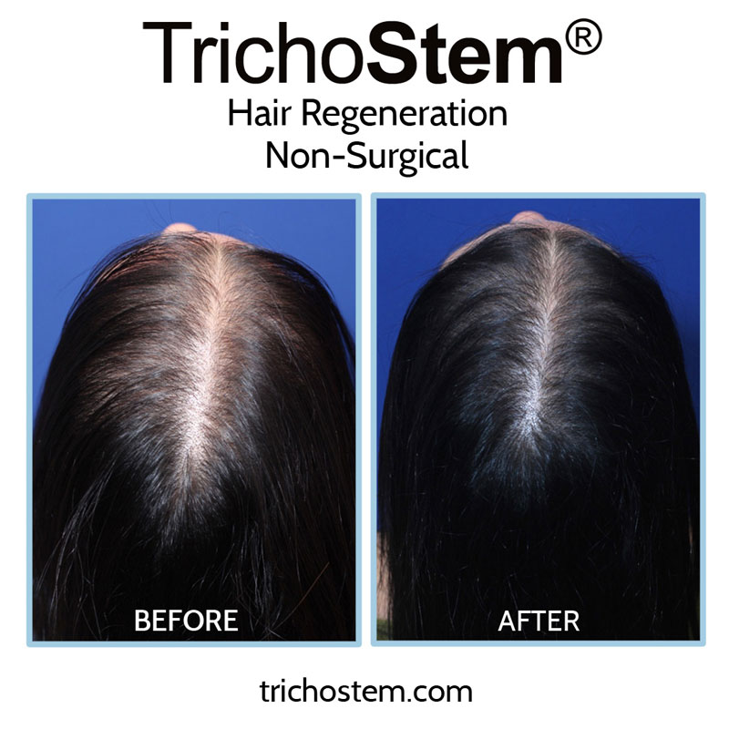 After improving diagnosis of female pattern hair loss, TrichoStem Hair Regeneration attained a 99% success rate of treatment