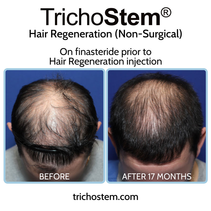 TrichoStem™ Hair Regeneration is best used with a DHT-blocker like finasteride, especially for you men with high DHT-sensitivity, and provides substantially greater scalp coverage than finasteride alone