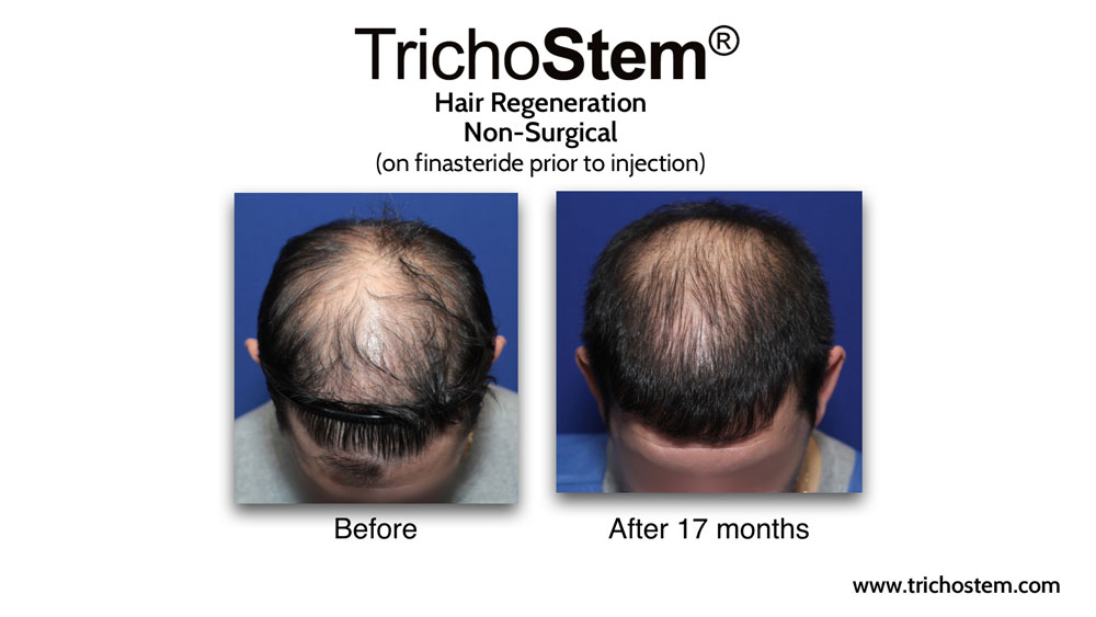 TrichoStem™ Hair Regeneration is best used with a DHT-blocker like finasteride, especially for you men with high DHT-sensitivity, and provides substantially greater scalp coverage than finasteride alone