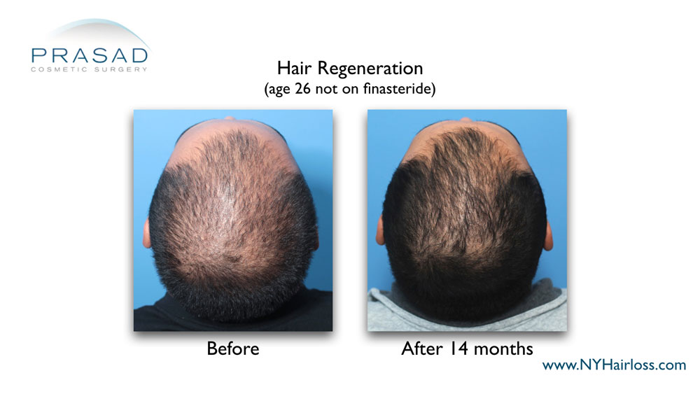 While TrichoStem Hair Regeneration has gotten impressive results in some young men not taking finasteride, a DHT-blocker is part of the treatment plan for best and longest lasting results