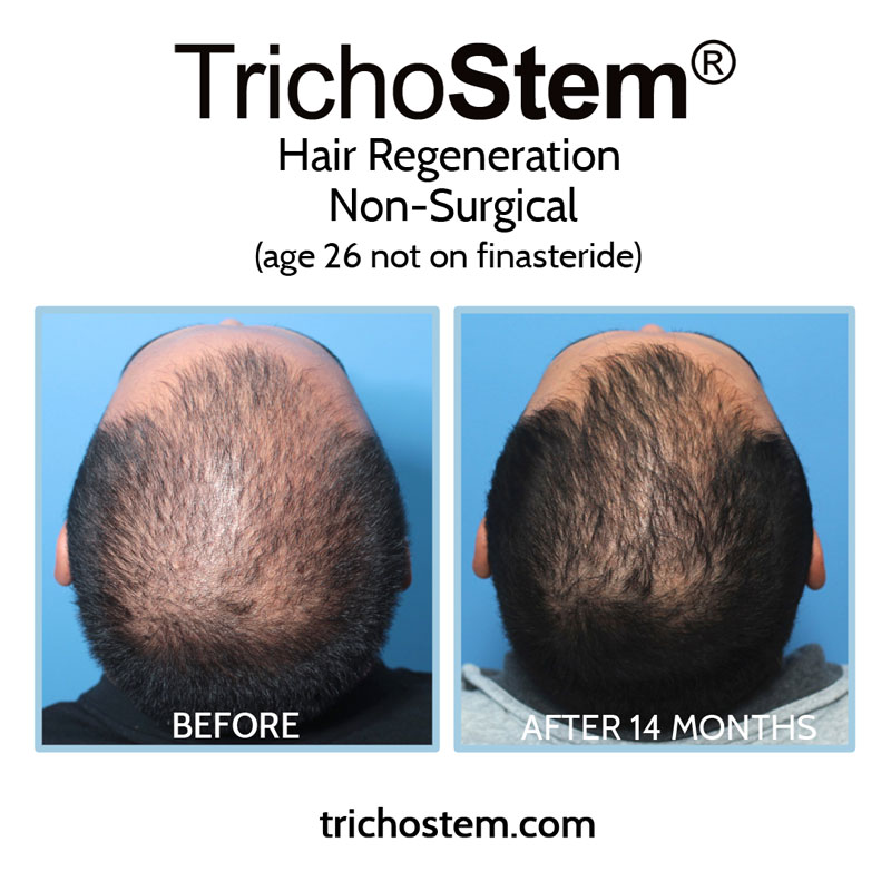 While TrichoStem Hair Regeneration has gotten impressive results in some young men not taking finasteride, a DHT-blocker is part of the treatment plan for best and longest lasting results