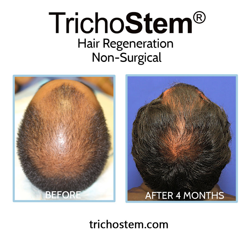 Regular follow-up sessions are important to show patients improvement in scalp coverage.