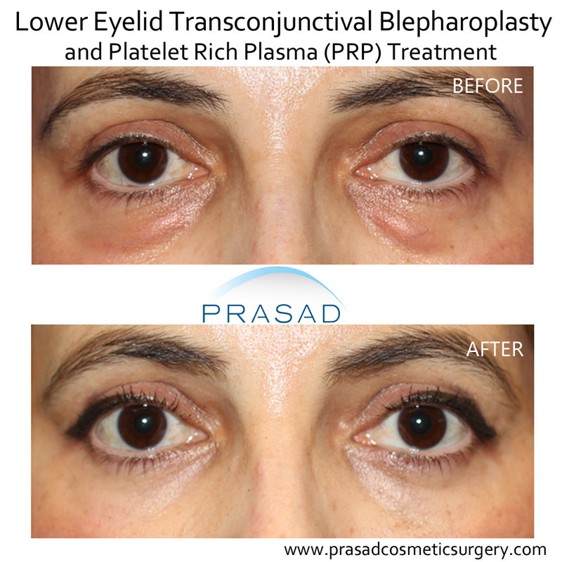 Skin quality, and healing after upper and lower eyelid surgery can be improved with PRP applied