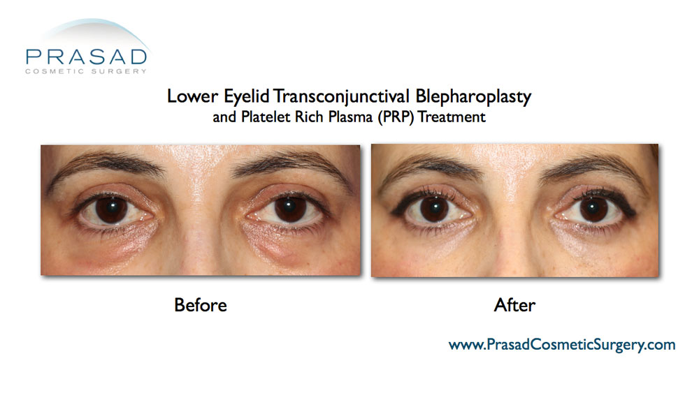 Skin quality, and healing after upper and lower eyelid surgery can be improved with PRP