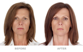 PRP for skin rejuvenation before and after