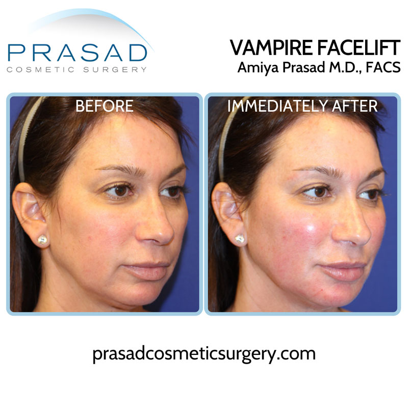 before and immediately after Vampire Facelift®