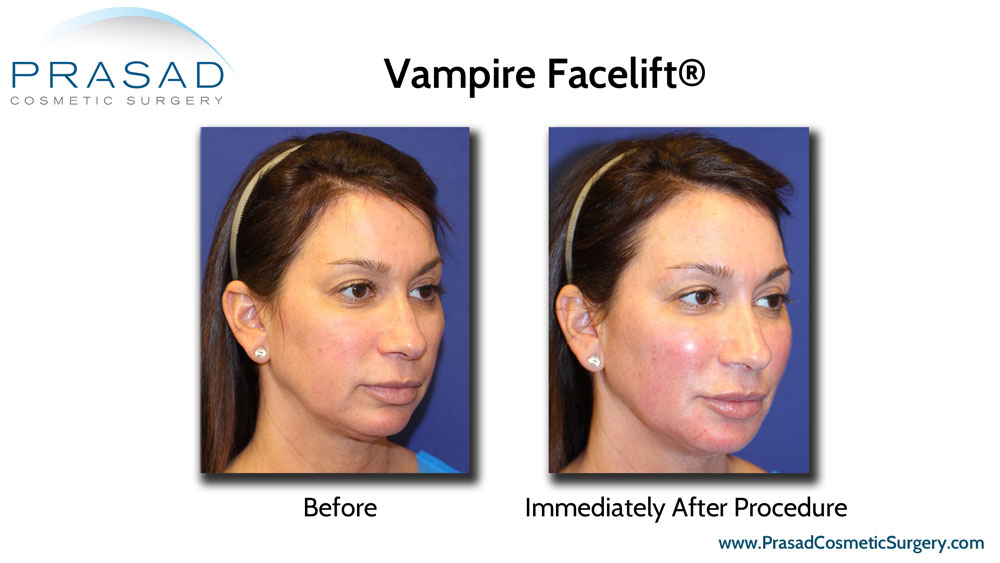 Vampire Facelift® before and immediately after procedure