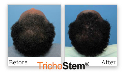 TrichoStem Hair Regeneration Patient Review - before and after treatment results on female pattern hair loss