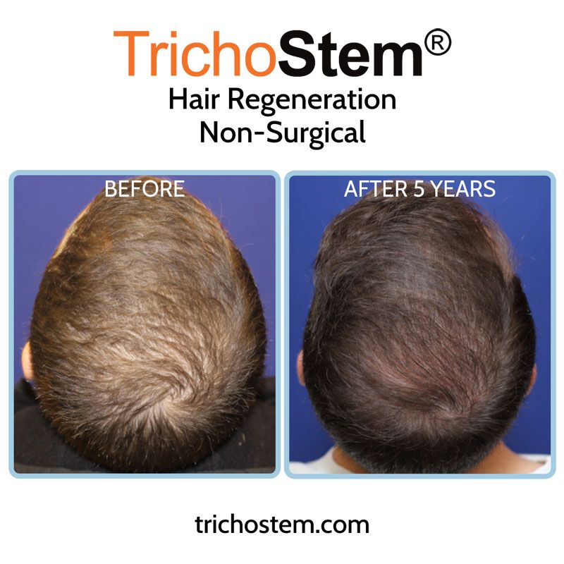 A male patient showing thicker scalp coverage five years after a single treatment of TrichoStem™ Hair Regeneration, and without using finasteride.