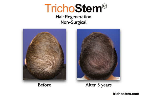 A male patient showing thicker scalp coverage five years after a single treatment of TrichoStem™ Hair Regeneration, and without using finasteride.