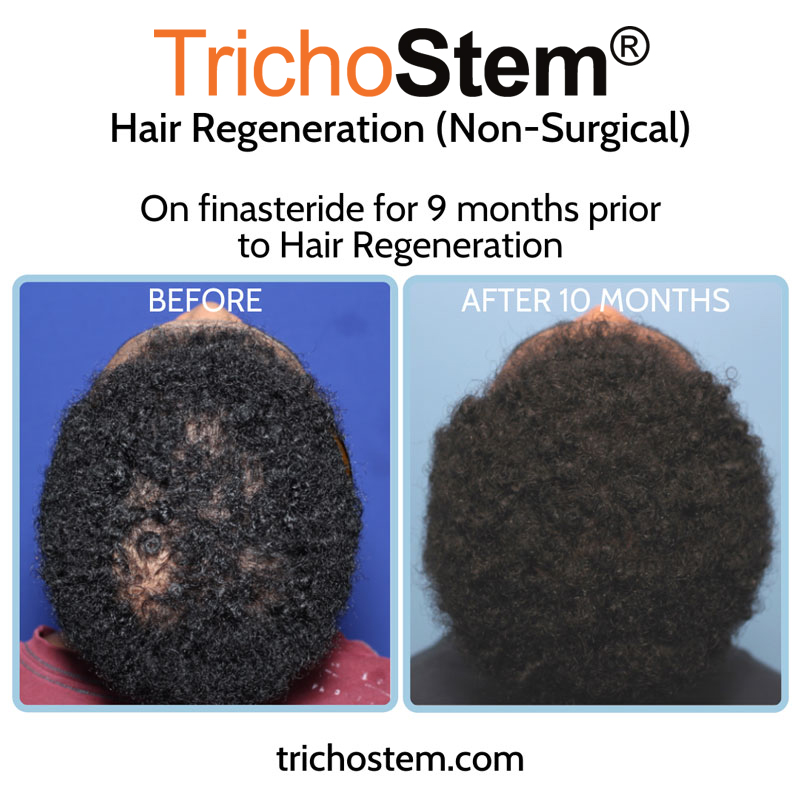 This male patient was taking finasteride for 9 months prior to TrichoStem® Hair Regeneration treatment to help with high DHT-sensitivity. The difference from finasteride treatment alone is clearly seen.