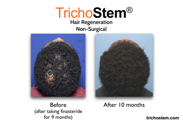 This male patient was taking finasteride for 9 months prior to TrichoStem® Hair Regeneration treatment to help with high DHT-sensitivity. The difference from finasteride treatment alone is clearly seen.