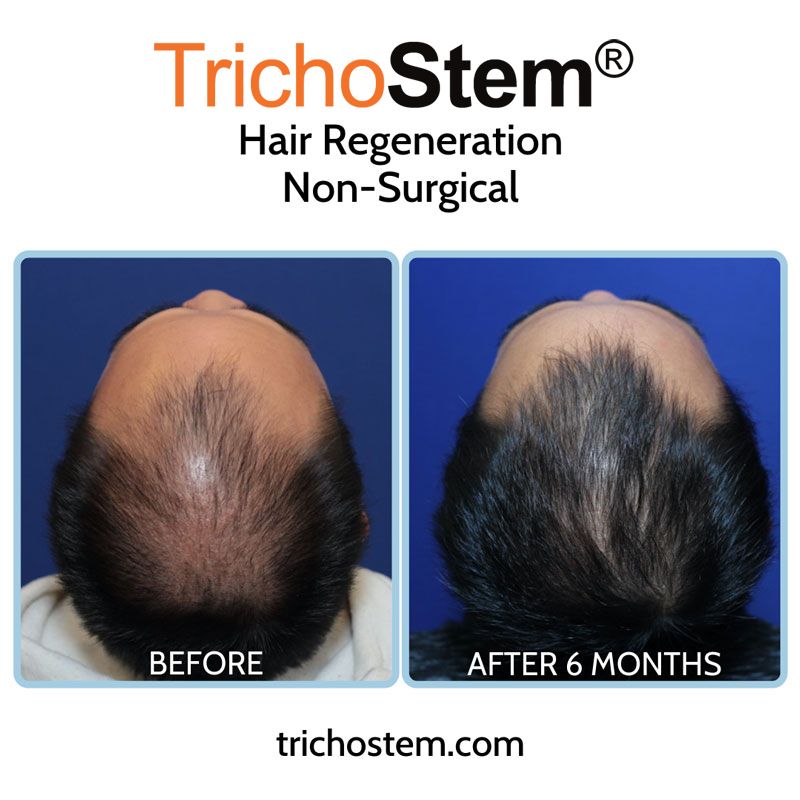 As pattern hair loss characteristics differ for individuals, these are factored in the customization of TrichoStem™ Hair Regeneration for each individual