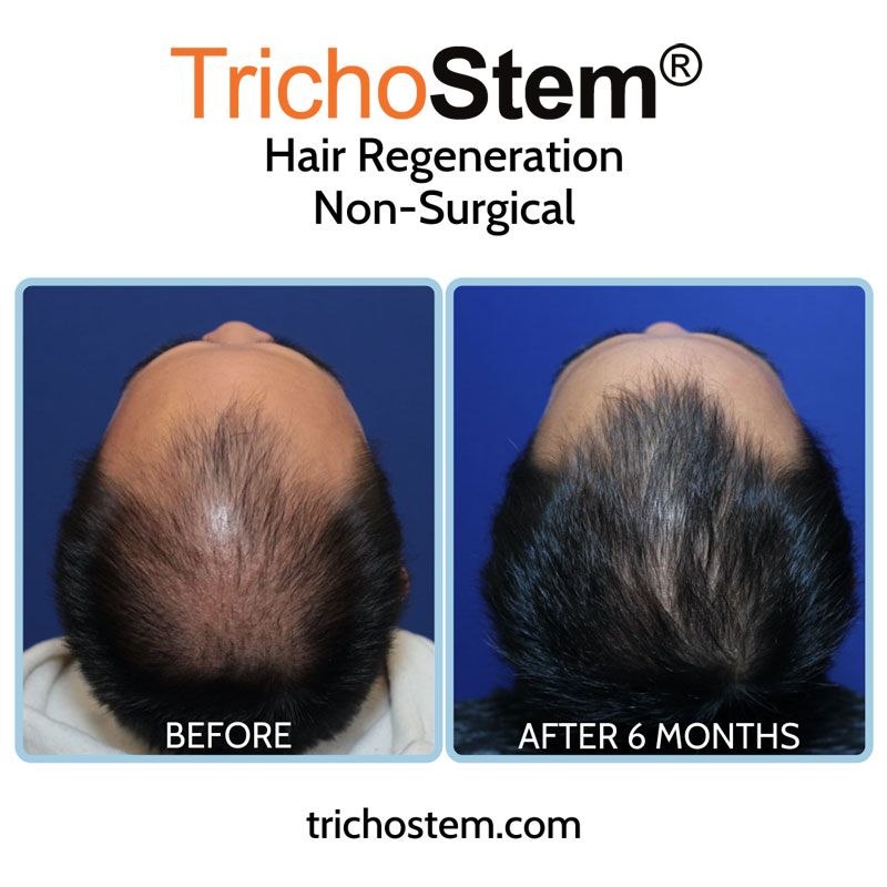 As pattern hair loss characteristics differ for individuals, these are factored in the customization of TrichoStem™ Hair Regeneration for each individual