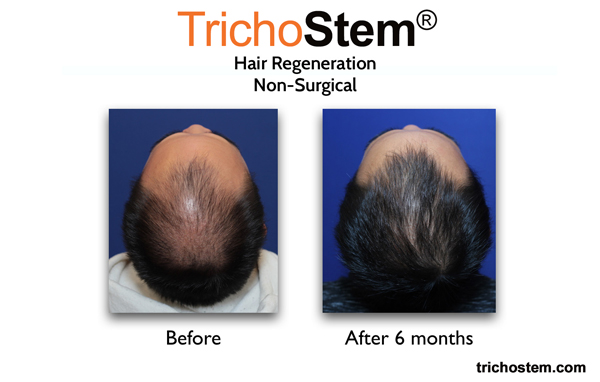 As pattern hair loss characteristics differ for individuals, these are factored in the customization of TrichoStem™ Hair Regeneration for each individual