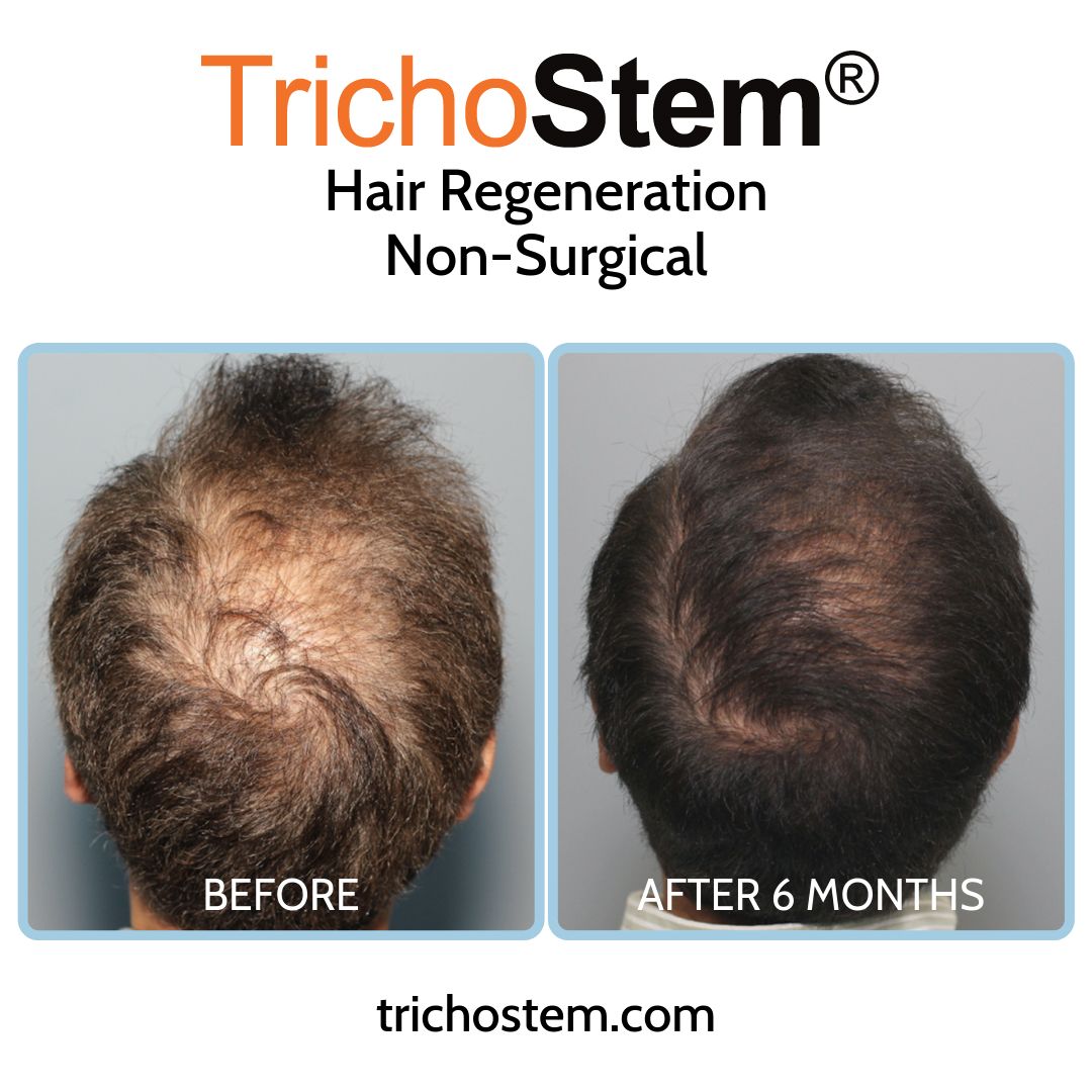 hair regeneration customized treatment formulation before and after 6 months results