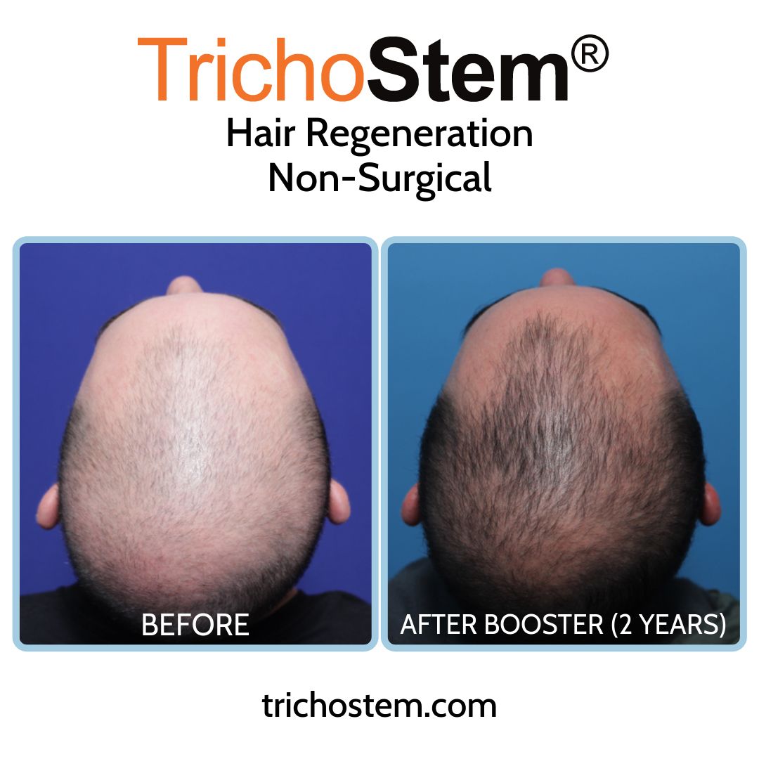before and 2 years after The TrichoStem® Hair Regeneration treatment