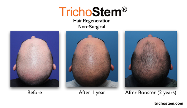before, 1 year after and 2 years after hair regeneration treatment with Regular follow-up sessions to monitor patients improvement in scalp coverage.