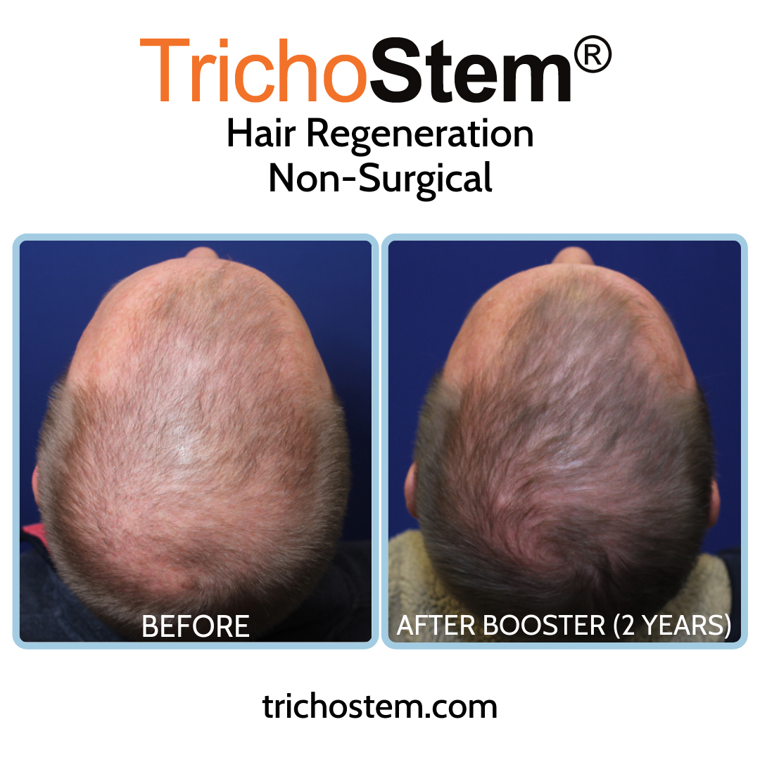 Male patient with significant thinning achieved considerably denser hair coverage after two TrichoStem® Hair Regeneration treatment sessions.