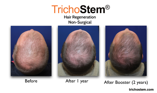 Male patient with significant thinning achieved considerably denser hair coverage after two TrichoStem® Hair Regeneration treatment sessions.