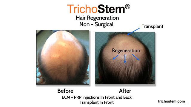 before and after hair regeneration treatment. New hairs grows in non-transplant areas using ECM by ACell