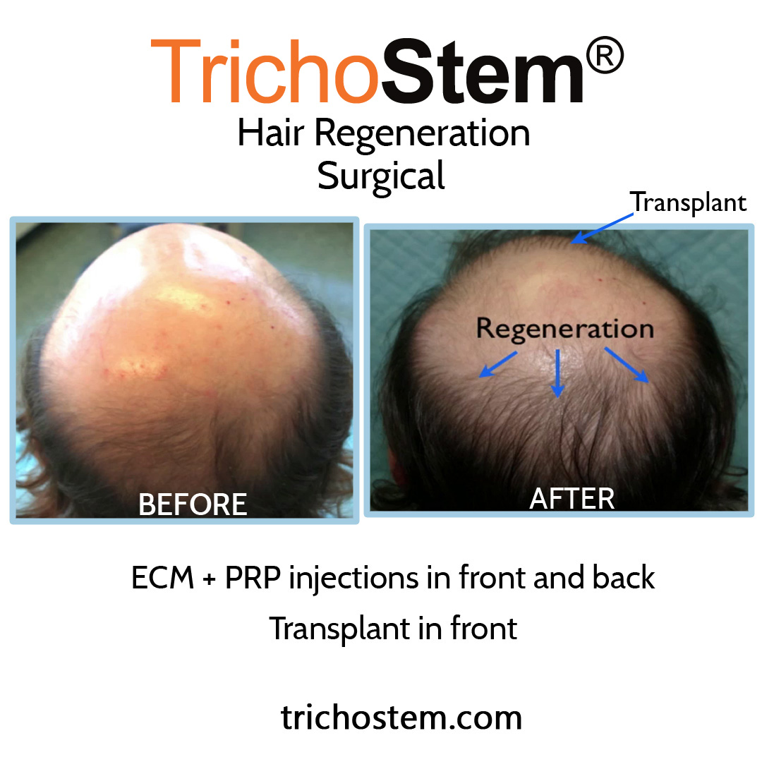 before and after hair regeneration treatment - thicken existing thinning hairs