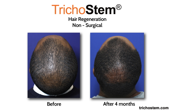 A male TrichoStem™ Hair Regeneration patient showing significant improvement after only 4 months and a single treatment session