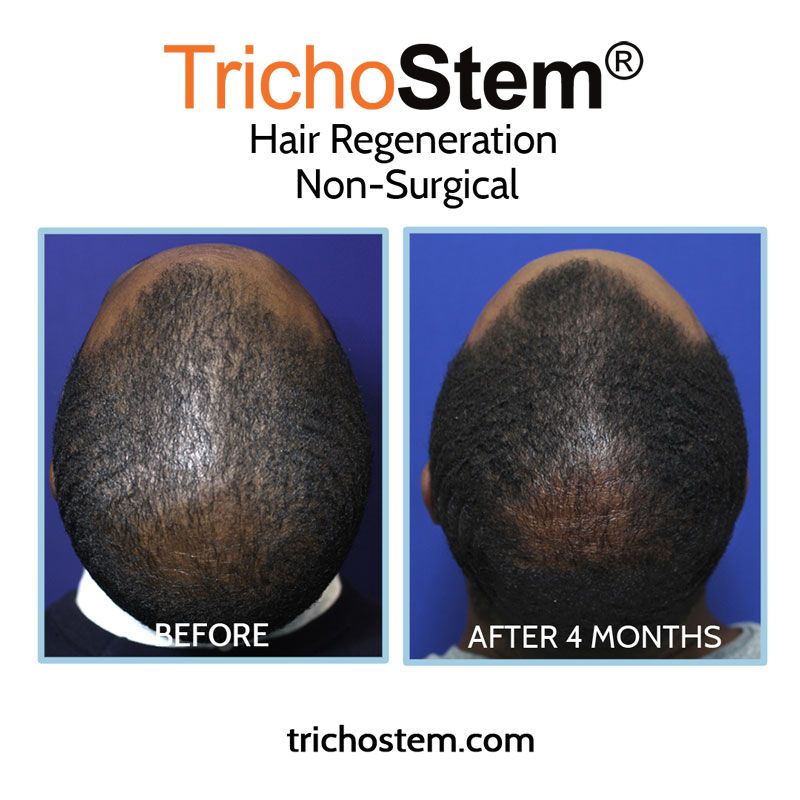 A male TrichoStem™ Hair Regeneration patient showing significant improvement after only 4 months and a single treatment session