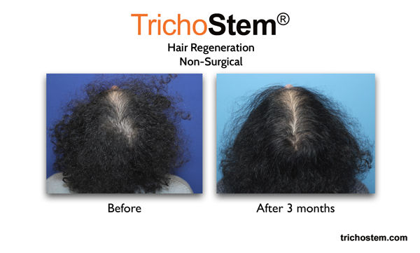 hair regeneration treatment before and after 3 months