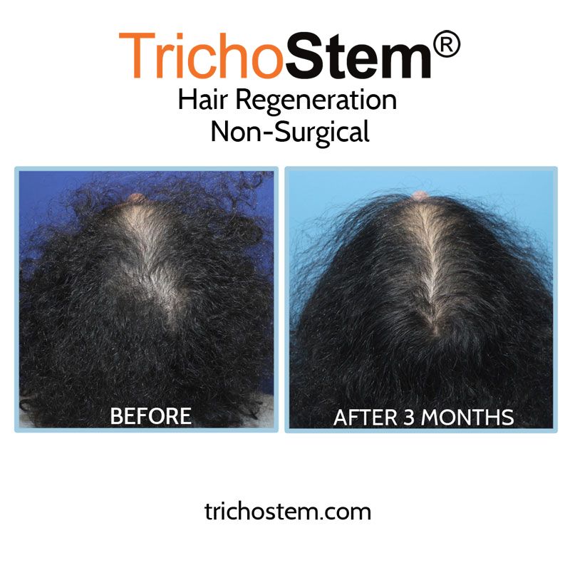 hair regeneration treatment before and after 3 months