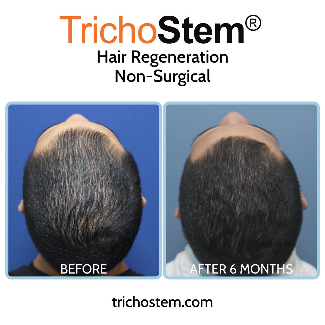 Effectiveness of TrichoStem® Hair Regeneration treatment after 6 months and a single injection