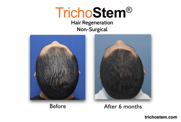 Effectiveness of TrichoStem® Hair Regeneration treatment after 6 months and a single injection