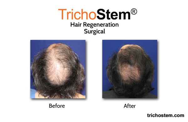before and after hair transplant + hair regeneration