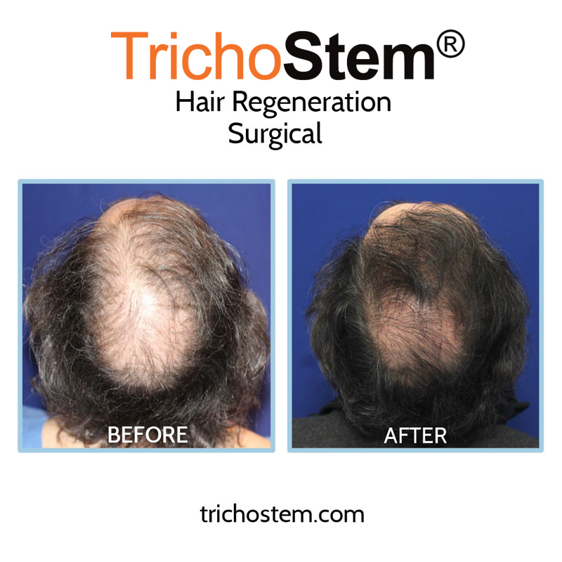 before and after hair tranplant and TrichoStem® Hair Regeneration treatment