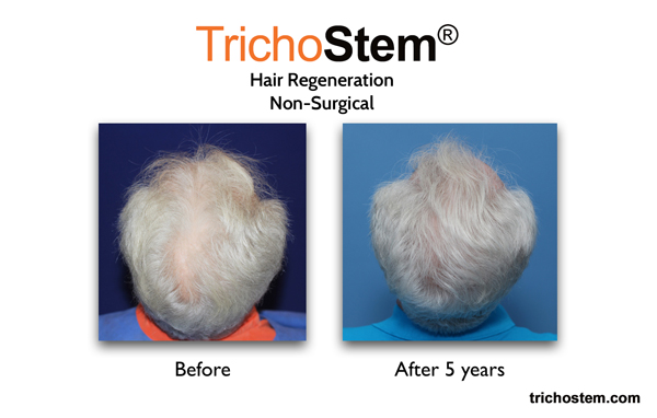 TrichoStem® Hair Regeneration results in a male patient with moderate hair thinning 5 years after a single injection and no finasteride